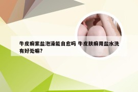 牛皮癣紫盐泡澡能自愈吗 牛皮肤癣用盐水洗有好处嘛?