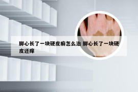 脚心长了一块硬皮癣怎么治 脚心长了一块硬皮还痒