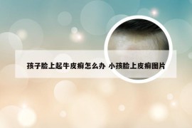 孩子脸上起牛皮癣怎么办 小孩脸上皮癣图片