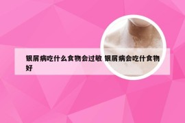银屑病吃什么食物会过敏 银屑病会吃什食物好