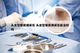 头皮型银屑病采乐 头皮型银屑病采乐能治好吗