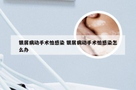 银屑病动手术怕感染 银屑病动手术怕感染怎么办