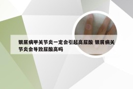 银屑病甲关节炎一定会引起高尿酸 银屑病关节炎会导致尿酸高吗