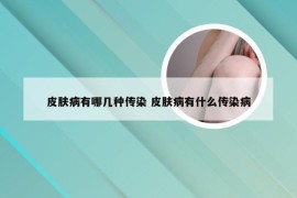 皮肤病有哪几种传染 皮肤病有什么传染病