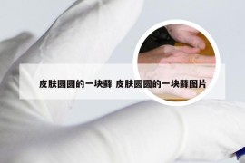皮肤圆圆的一块藓 皮肤圆圆的一块藓图片