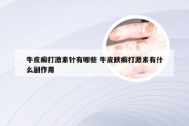 牛皮癣打激素针有哪些 牛皮肤癣打激素有什么副作用