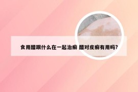 食用醋跟什么在一起治癣 醋对皮癣有用吗?