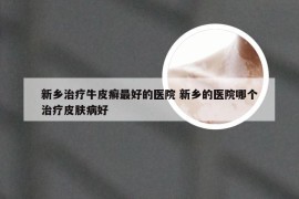 新乡治疗牛皮癣最好的医院 新乡的医院哪个治疗皮肤病好