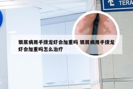 银屑病用手拨龙虾会加重吗 银屑病用手拨龙虾会加重吗怎么治疗