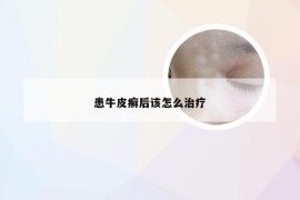 患牛皮癣后该怎么治疗