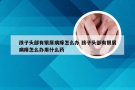 孩子头部有银屑病痒怎么办 孩子头部有银屑病痒怎么办用什么药