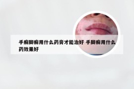 手癣脚癣用什么药膏才能治好 手脚癣用什么药效果好