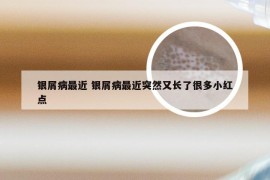 银屑病最近 银屑病最近突然又长了很多小红点