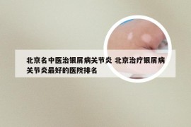 北京名中医治银屑病关节炎 北京治疗银屑病关节炎最好的医院排名