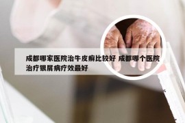 成都哪家医院治牛皮癣比较好 成都哪个医院治疗银屑病疗效最好