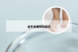 治牛皮癣特效配方