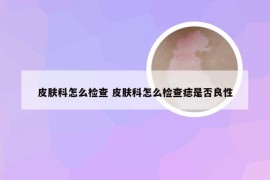 皮肤科怎么检查 皮肤科怎么检查痣是否良性