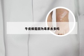 牛皮癣是因为毒素太多吗