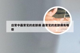 日常中最常见的皮肤病 最常见的皮肤病有哪些