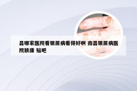 昌哪家医院看银屑病看得好啊 南昌银屑病医院肤康 贴吧