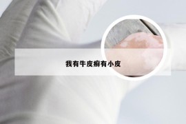 我有牛皮癣有小皮