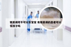 银屑病可不可以生宝宝 有银屑病的患者可以生孩子吗