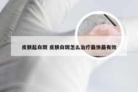 皮肤起白斑 皮肤白斑怎么治疗最快最有效