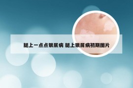 腿上一点点银屑病 腿上银屑病初期图片