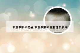 银屑病科研热点 银屑病的研究有什么新闻