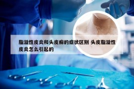 脂溢性皮炎和头皮癣的症状区别 头皮脂溢性皮炎怎么引起的