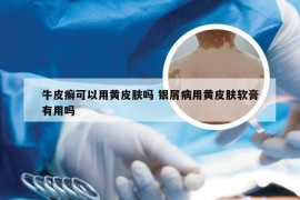 牛皮癣可以用黄皮肤吗 银屑病用黄皮肤软膏有用吗