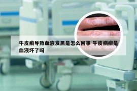 牛皮癣导致血液发黑是怎么回事 牛皮病癣是血液坏了吗