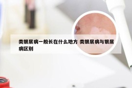 类银屑病一般长在什么地方 类银屑病与银屑病区别