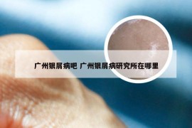广州银屑病吧 广州银屑病研究所在哪里