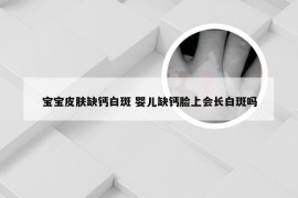 宝宝皮肤缺钙白斑 婴儿缺钙脸上会长白斑吗