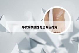牛皮癣的临床分型及治疗方