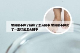 银屑病不痒了结痂了怎么回事 银屑病不掉皮了一直红是怎么回事