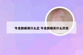 牛皮肤癣用什么志 牛皮肤癣买什么药膏