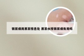 银屑病用黑茶擦患处 黑茶水擦银屑病有用吗