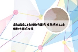 皮肤病吃21金维他有用吗 皮肤病吃21金维他有用吗女性