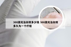 308激光治白斑多少钱 308激光治白斑多久为一个疗程