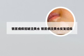 银屑病痒抠破流黄水 银屑病流黄水反复结痂