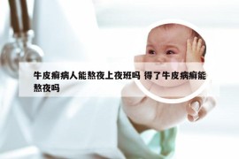 牛皮癣病人能熬夜上夜班吗 得了牛皮病癣能熬夜吗