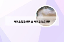 双氧水能治银屑病 双氧水治疗银屑
