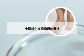 中医对牛皮癣病因的看法