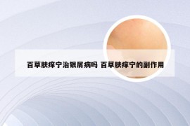 百草肤痒宁治银屑病吗 百草肤痒宁的副作用