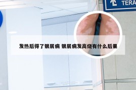 发热后得了银屑病 银屑病发高烧有什么后果