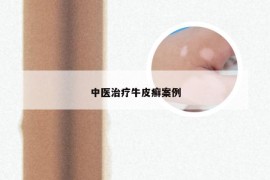 中医治疗牛皮癣案例