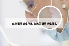 血热银屑病吃什么 血热型银屑病吃什么