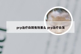 prp治疗白斑有效果么 prp治疗白发